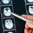 Novo remédio pode mudar o destino de pacientes com Alzheimer; entenda (Freepik)